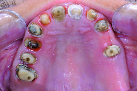 2. Situazione clinica alla rimozione delle corone, evidenti infiltrazioni a carico di tutti gli elementi dentari.