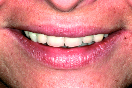 2. Caso clinico iniziale: close-up del sorriso.