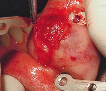 4. Scollamento della sottilissima mucosa sovrastante la lesione. 