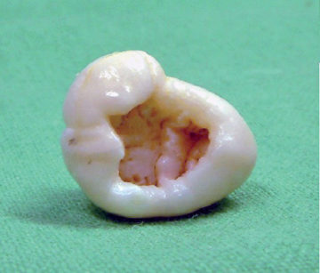1a-1c. “Dens in dente” multipli in paziente affetto da sindrome di Ekman-Westborg-Julin.