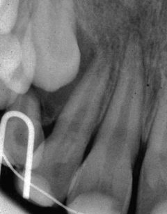 2. Invaginazione di tipo 1 secondo Oehlers in corrispondenza del dente 12, con radiolucenza apicale.