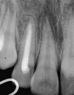 3. La radiografia a 10 mesi dall’intervento mostra l’otturazione del canale radicolare del dente 12 e la riuscita della guarigione periapicale.