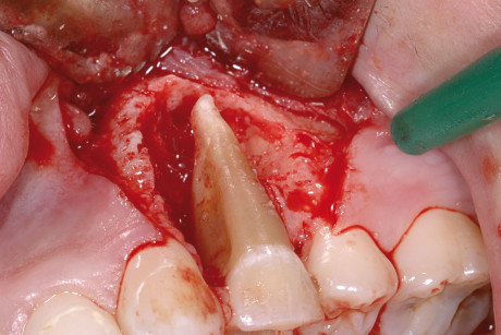 2. Immagine clinica intra-operatoria che evidenzia l’esteso deficit di osso alveolare intorno al premolare mascellare. 
