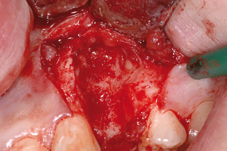 3. Immagine clinica intra-operatoria che evidenzia il deficit osseo dopo l’estrazione dell’elemento dentale interessato. 