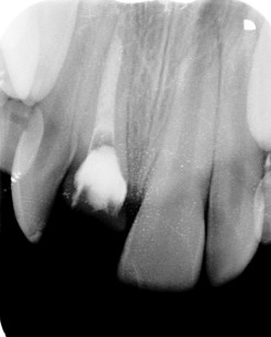 9. Radiografia endorale finale al termine della terapia endodontica per valutare tridimensionalità dell’otturazione e prevedibilità del trattamento.