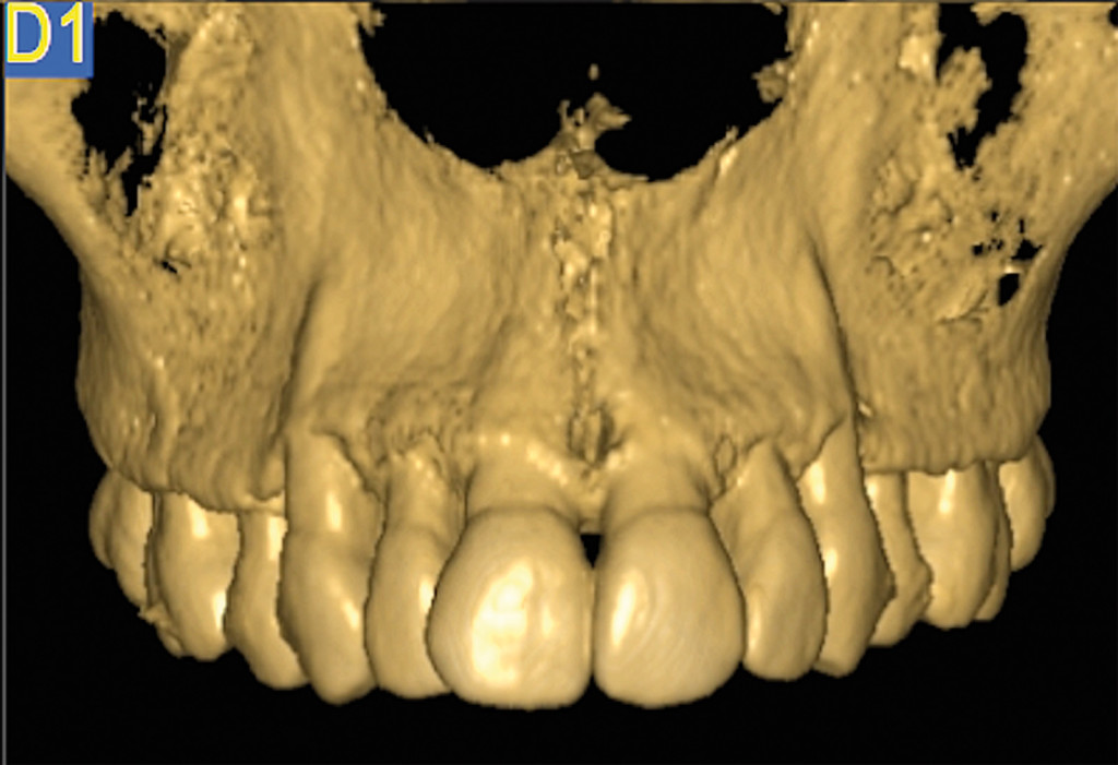 1. Intervento di corticotomia dento-alveolare. Espansione arcata mascellare; Tomografia computerizzata; proiezione frontale.