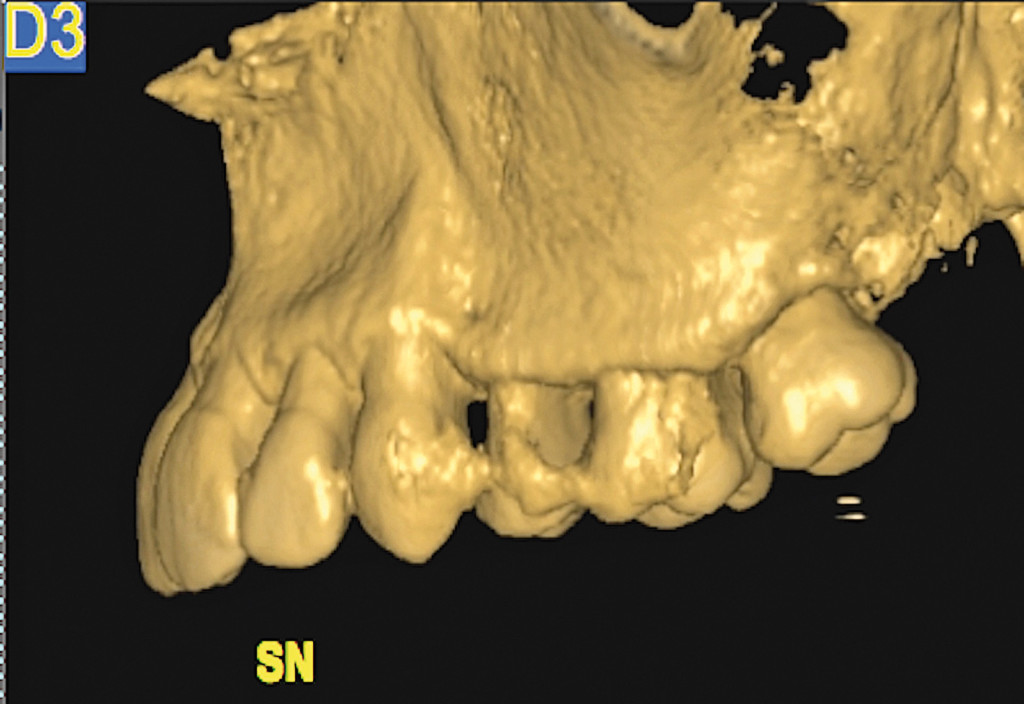3. Intervento di corticotomia dento-alveolare. Espansione arcata mascellare; Tomografia computerizzata; proiezione sagittale, lato sinistro.