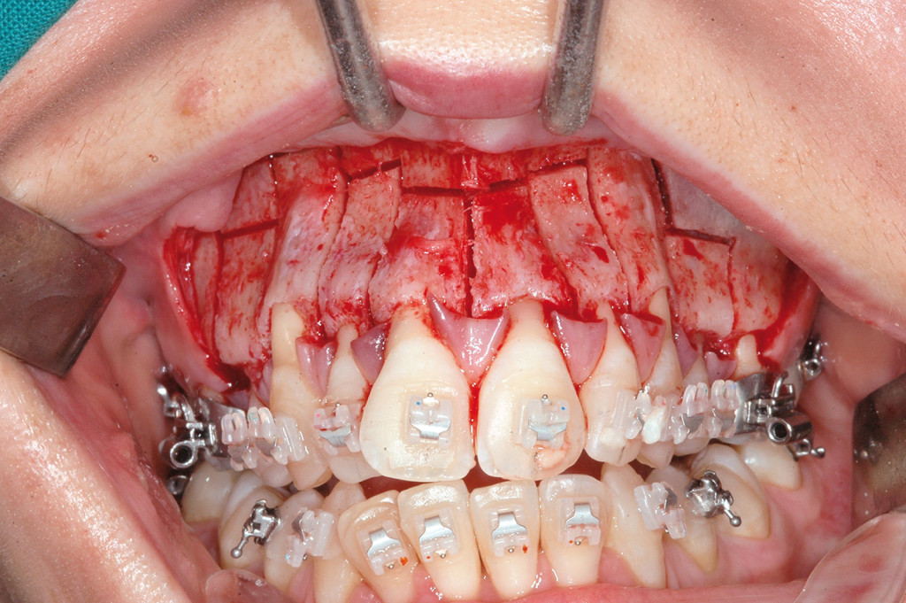6. Intervento di corticotomia dento-alveolare. Espansione arcata mascellare.