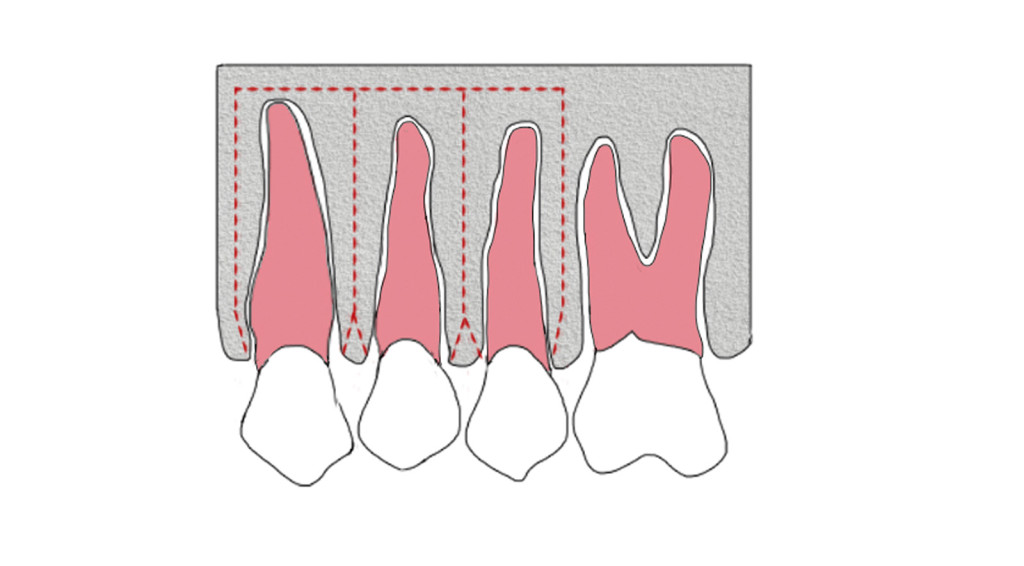 8. Rappresentazione della tecnica di corticotomia dento-alveolare secondo Wilcko.