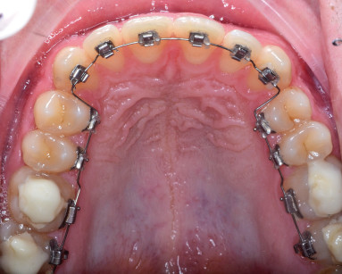 10a-b. Ortodonzia linguale (si ringrazia il dr. A. Greco per le foto).