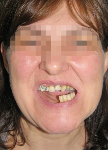 1. La paziente dopo il trauma mandibolare con grave malocclusione e deformità del terzo inferiore del volto.