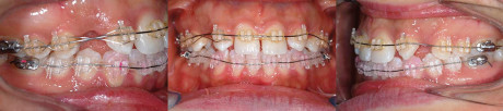 4. Trattamento ortodontico SW MBT a 4 mesi.
