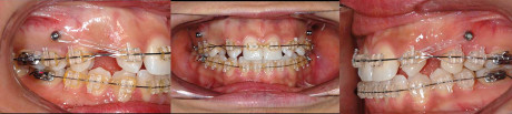 5. Trattamento ortodontico SW MBT a 5 mesi.