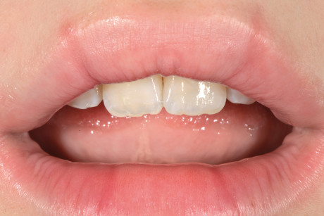 31. Immagine del sorriso del paziente; da notare la perfetta armonia della ricostruzione con le labbra.