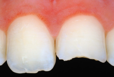32. È molto utile eseguire una foto con polarizzatore per poter avere maggiori informazioni sulle caratteristiche del dente da ricostruire.