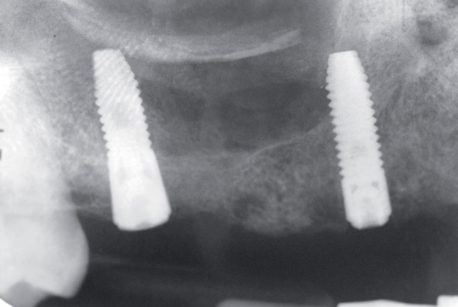 3. Radiografia endorale post-intervento. Ben visibile la botola di osso sostenuta dagli impianti e la creazione di una cavità sottostante che sarà soggetta a rigenerazione ossea.