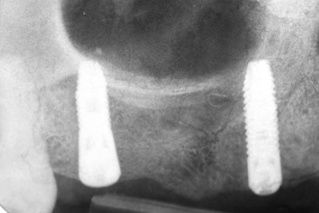 4. Radiografia endorale di controllo a 6 mesi; si nota il riempimento della cavità creata nell’intervento di rialzo del seno mascellare con materiale radiopaco organizzato, strutturalmente simile all’osso nativo circostante.