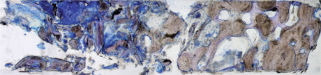 7. Valutazione al microscopio ottico: campione caratterizzato dall’ampia presenza di tessuto osteoide (blu) immaturo nella porzione sinistra della figura che rappresenta la parte apicale del prelievo. Nella parte destra della figura si evidenzia il tessuto osso maturo (cresta alveolare residua prima del rialzo del seno mascellare) che comprende osso lamellare, spazi midollari e matrice osteoide che caratterizza i processi di rimodellamento fisiologico dell’osso.