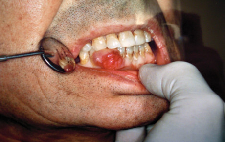 2. Visione della neoformazione e rapporti con l’arcata dentale. 