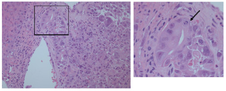 4. Aspetto istologico del prelievo della mucosa orale: nel corion mucoso è presente tessuto neoplastico con aspetti solidi e ghiandolari. Ematossilina eosina, ingrandimento originale 20X. Si noti, a destra, una cellula in mitosi (freccia). Close-up del riquadro di sinistra 60X. 
