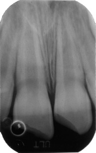 4. Paziente di 7 anni. a. Frattura smalto-dentinale profonda ma non complicata di 1.1 e 2.1 con concomitante concussione. b. La radiografia endorale mostra l’immaturità radicolare.