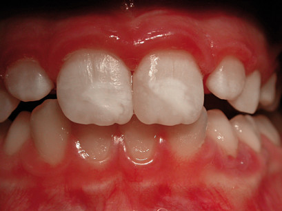 5. a. Preparazione dei margini e decontaminazione della superficie dentinale esposta eseguita con laser Erbium. b. Il restauro finale.