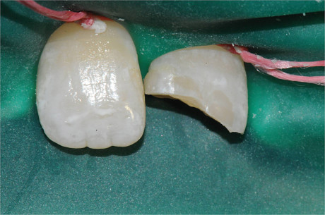 7. a,b. Frattura smalto-dentinale non complicata di 2.1. (Per gentile concessione del professor Romano Grandini)