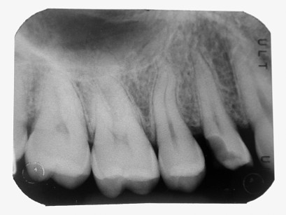 12. Radiografia endorale pre-operatoria: si evidenzia la profondità della lesione, che richiede un trattamento dentinale profondo di decontaminazione e sigillatura dentinale. 
