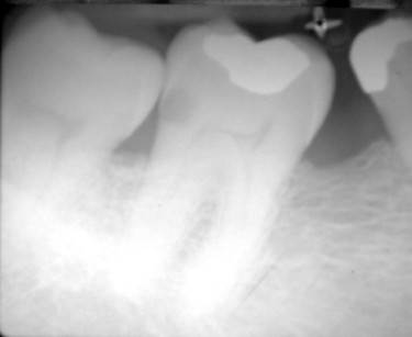 2 e 3. Quadro clinico e radiografico di un secondo molare inferiore prima dell’estrazione del terzo molare e successivamente all’estrazione stessa in previsione di eseguire un restauro OD in Kalore. 