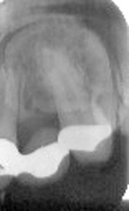 4. Radiografia endorale prima del trattamento ortodontico. Si noti l’insufficiente correzione degli assi radicolari.