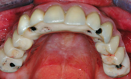 3-4. La protesi una volta rifinita viene posizionata in bocca al paziente il giorno stesso dell’intervento.