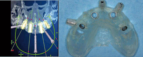 7. Pianificazione 3D del progetto protesico e dima chirurgica ottenuta mediante duplicazione stereolitografica (Software NobelGuide™). 