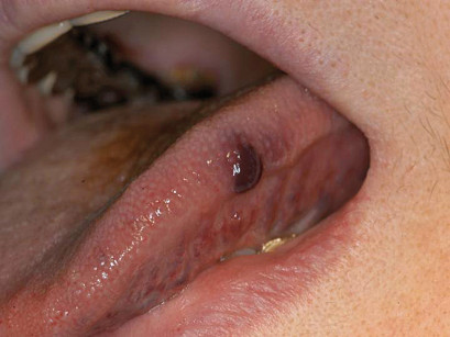 1. Lesione angiomatosa al margine linguale in una giovane paziente di 28 anni