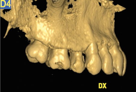 2. Intervento di corticotomia dento-alveolare. Espansione arcata mascellare; Tomografia computerizzata; proiezione sagittale, lato destro.