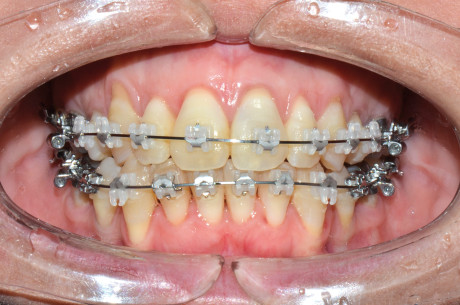 7. Intervento di corticotomia dento-alveolare. Espansione arcata mascellare; controllo.