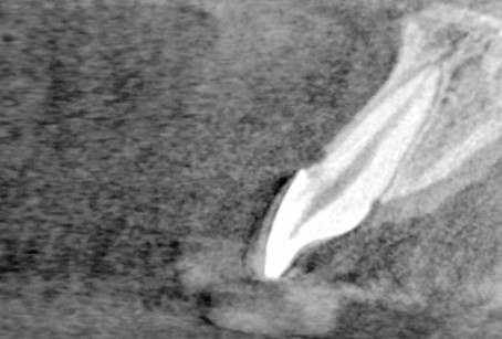 3. La tomografia computerizzata Cone Beam mostra come la lesione di classe 1 a carico dell’elemento 11 tenda a sottominare lo smalto in direzione coronale.