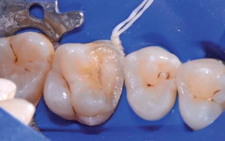 3. Rilocazione del margine cervicale mesiale, build-up e preparazione del dente.