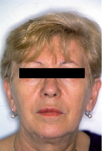 1. Fotografia del volto all’inizio del trattamento. 