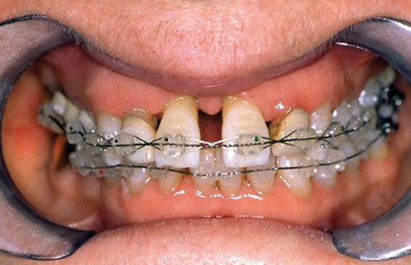 5. Visione intra-orale durante il trattamento ortodontico. 