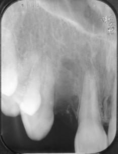 3. Radiografia endorale del difetto osseo prima del trattamento chirurgico.