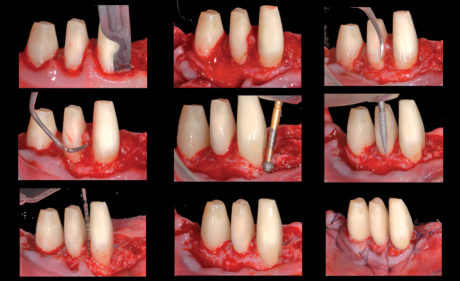 10-11. Chirurgia parodontale resettiva degli elementi 3.3, 3.4, 3.5, 4.3, 4.4, 4.5 atta al ripristino della fisiologica architettura positiva del tessuto osseo a supporto di tali elementi.