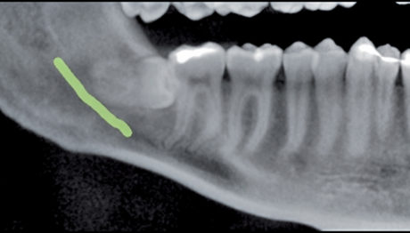 2. All’OPT si evidenzia una stretta relazione tra il terzo molare e il nervo alveolare inferiore