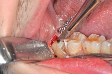 20. L’odontotomia viene completata con una leva dritta.