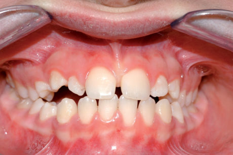 3. Ad eruzione dentaria completa permane il diastema anche se di dimensioni ridotte