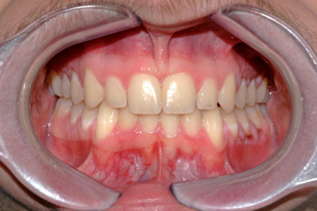 5. Paziente dopo terapia ortodontica di riallineamento: il diastema non è più presente e il frenulo permane ipertrofico senza implicazioni cliniche patologiche