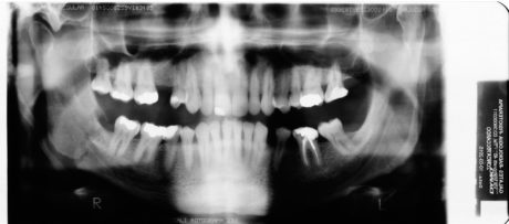 1a. Frattura angolo mandibolare destro durante l’estrazione del dente 48
