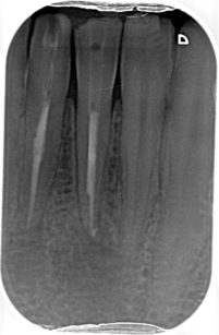 9c. Radiografia endorale dopo le devitalizzazioni dei denti 41-31