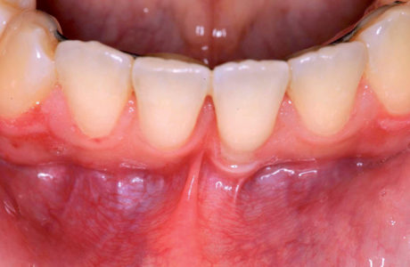10. Splintaggio linguale con filo ortodontico (a breve rimosso) e trazione del frenulo vestibolare in visione occlusale