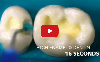 DM_il dentista moderno_ adesivo smalto dentinale_ total etch self etch_adesione in odontoiatria restaurativa