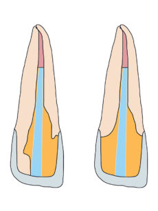 2. Corretta conservazione dei tessuti con l’utilizzo di un perno in fibra (sinistra) e inutile eliminazione di tessuti nella stessa situazione (destra).